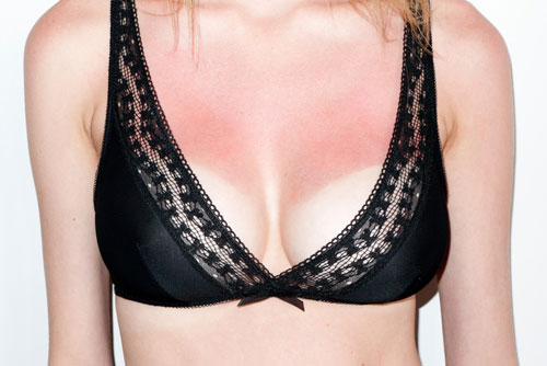 terry-richardson-sunburn